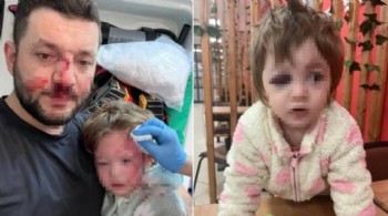 Komşunun saldırısında 14 aylık bebeğin kafatası çatladı!